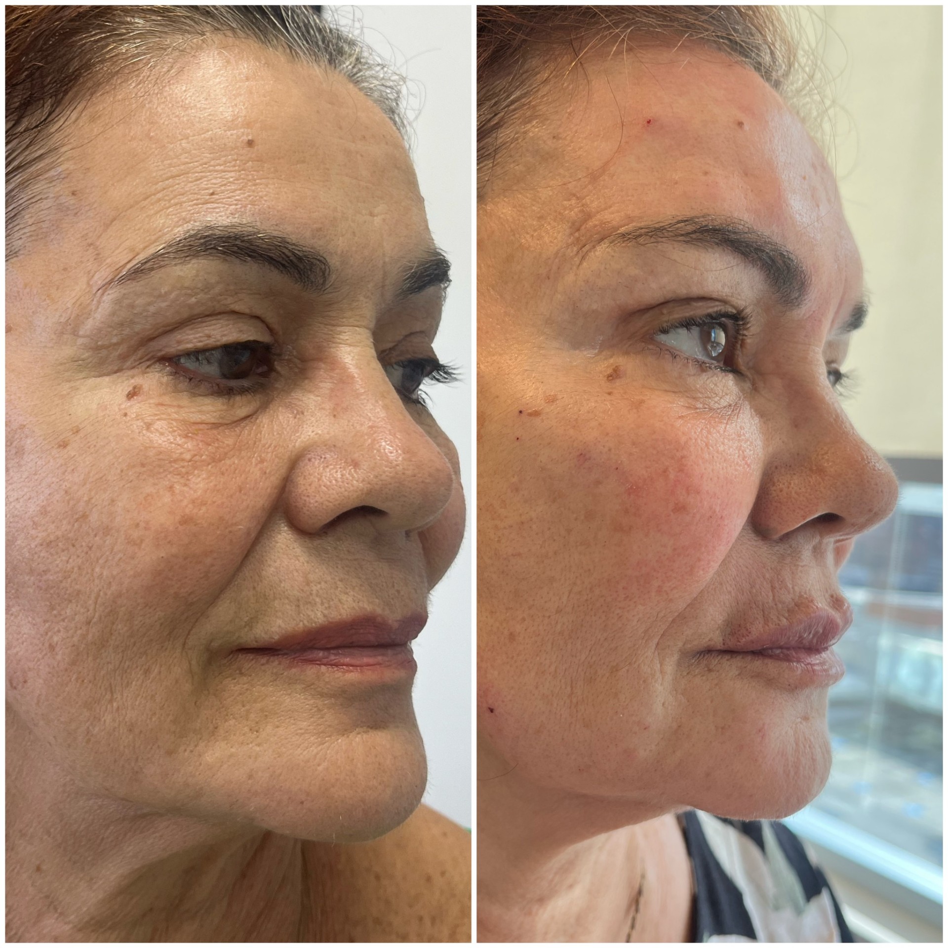 Antes e depois de harmonização facial em perfil