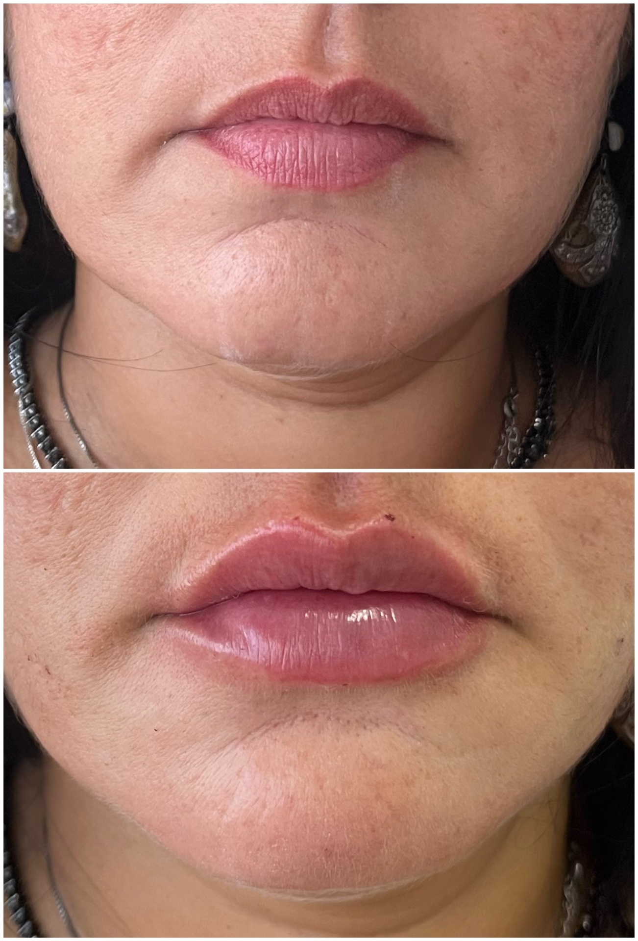 Antes e depois de preenchimento labial