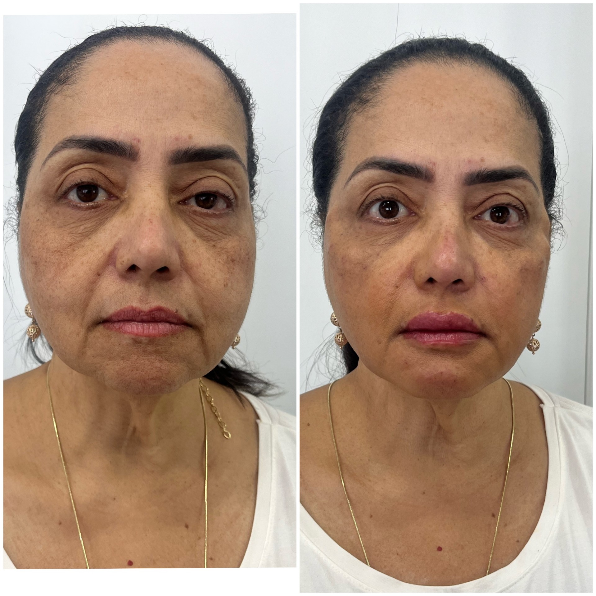 Antes e depois de tratamento facial de rejuvenescimento